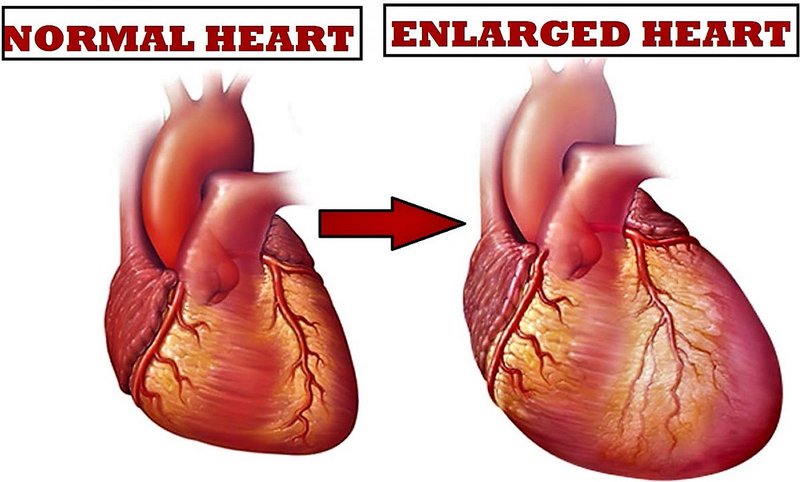 Apa Penyebab Pembesaran Jantung?
