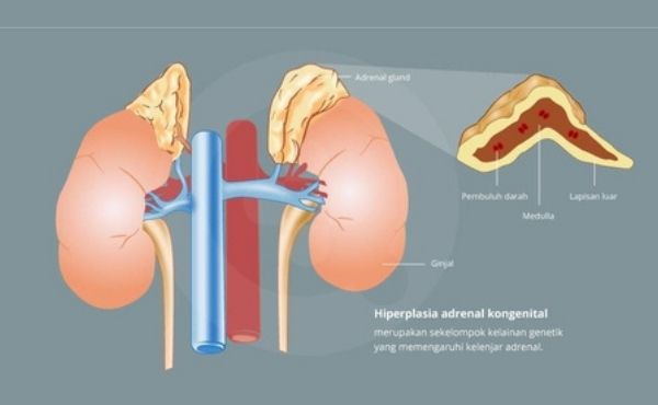 Apa itu Hiperplasia Adrenal Kongenital?